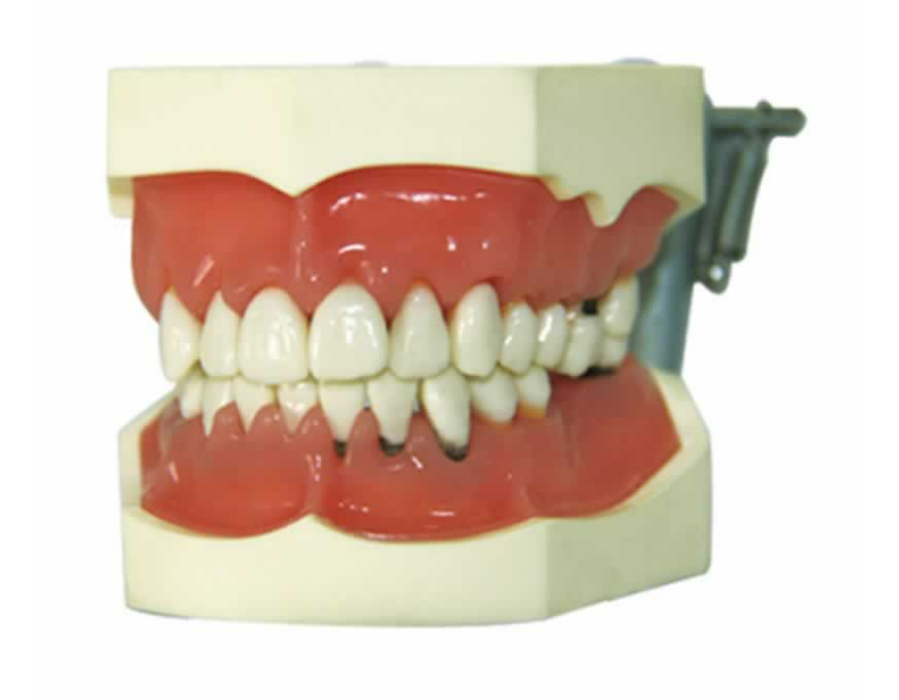 Jaw Model with Periodontal Disease