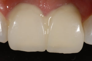 Allcem Veneer Try-In- LC resin cement for veneers Try in