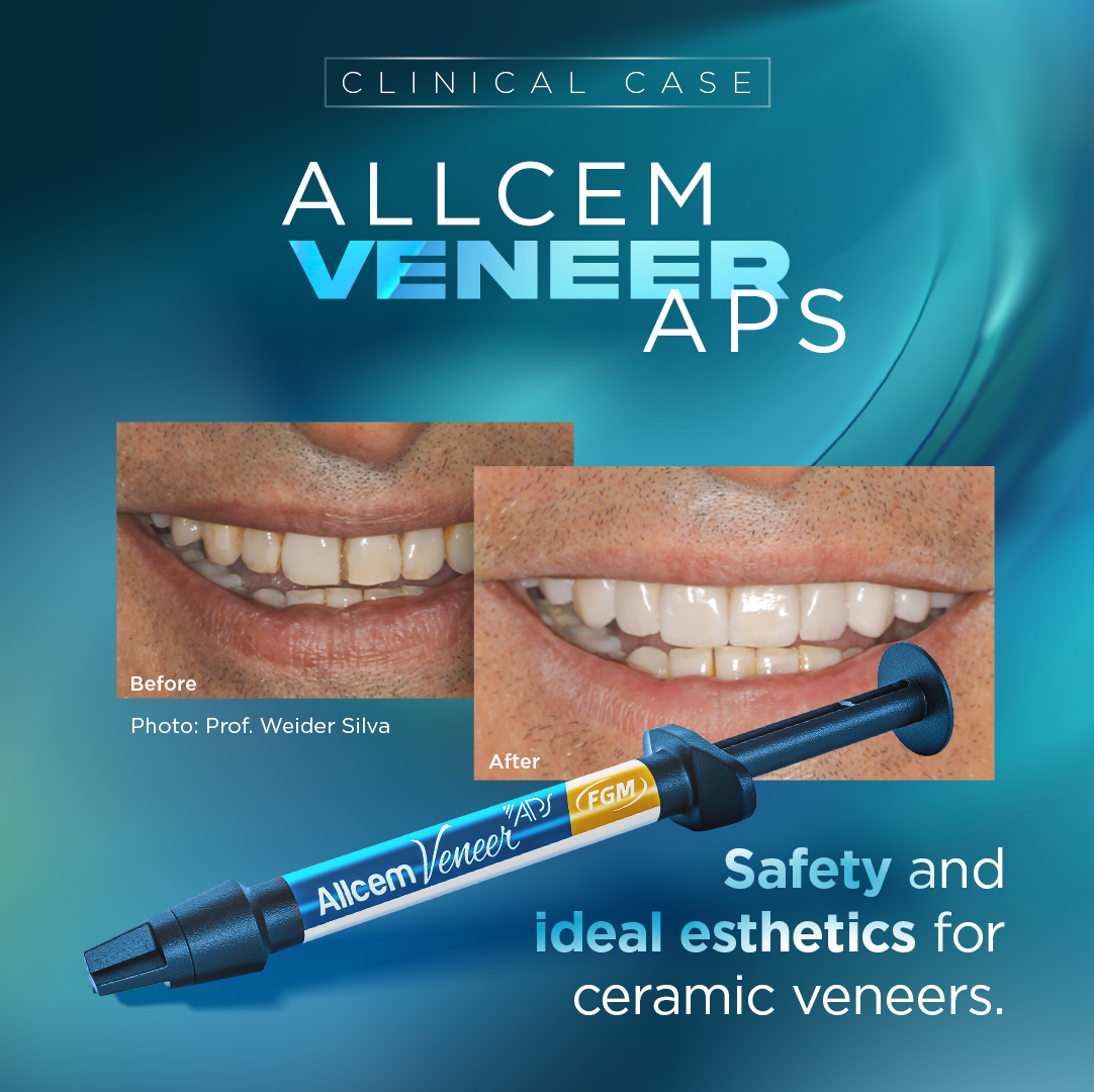 Allcem Veneer APS - Light-curing Resin Cement For Veneers & No-prep Veneers.