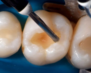 Opallis Flow Flowable Composite