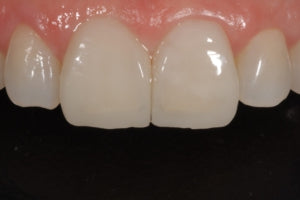 Allcem Veneer Try-In- LC resin cement for veneers Try in