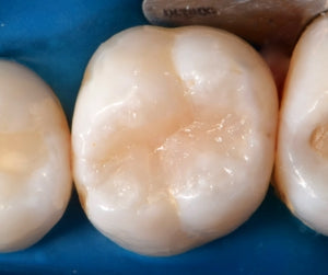 Opallis Flow Flowable Composite