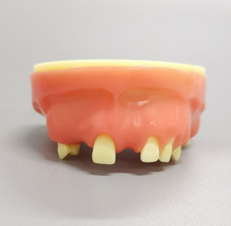 Implant Practice Model Upper Jaw Model Partially Edentulous Model