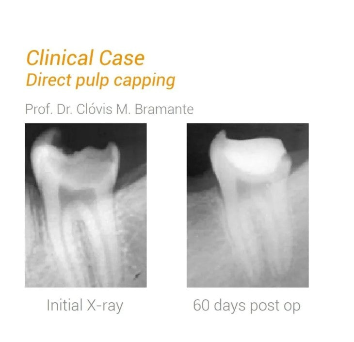 MTA Angelus - Bioceramic Reparative Cement