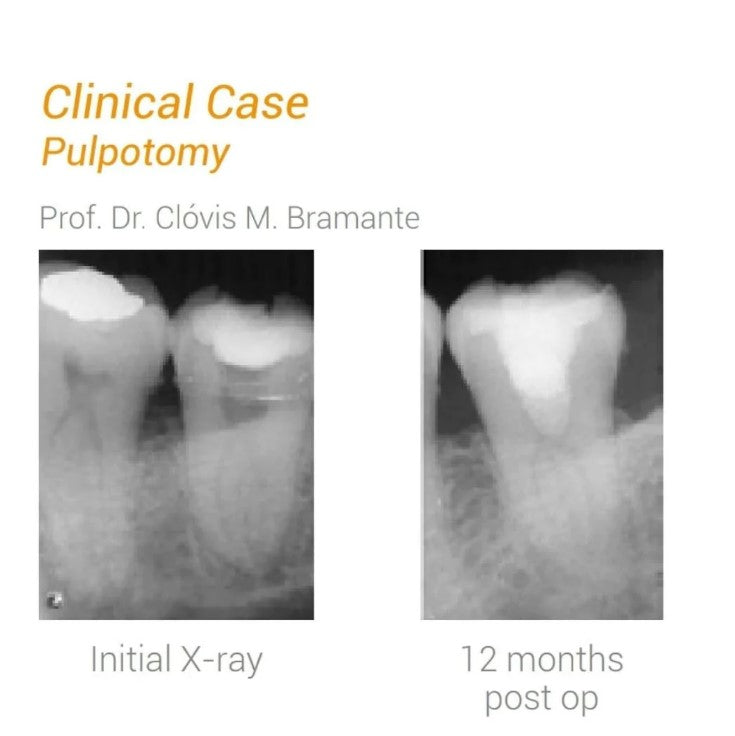 MTA Angelus - Bioceramic Reparative Cement