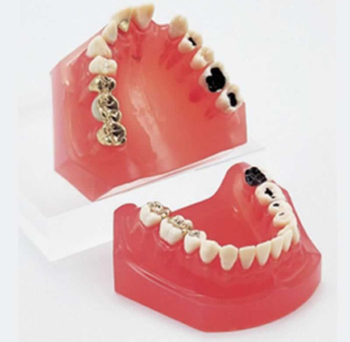 Caries Treatment Model Before & After