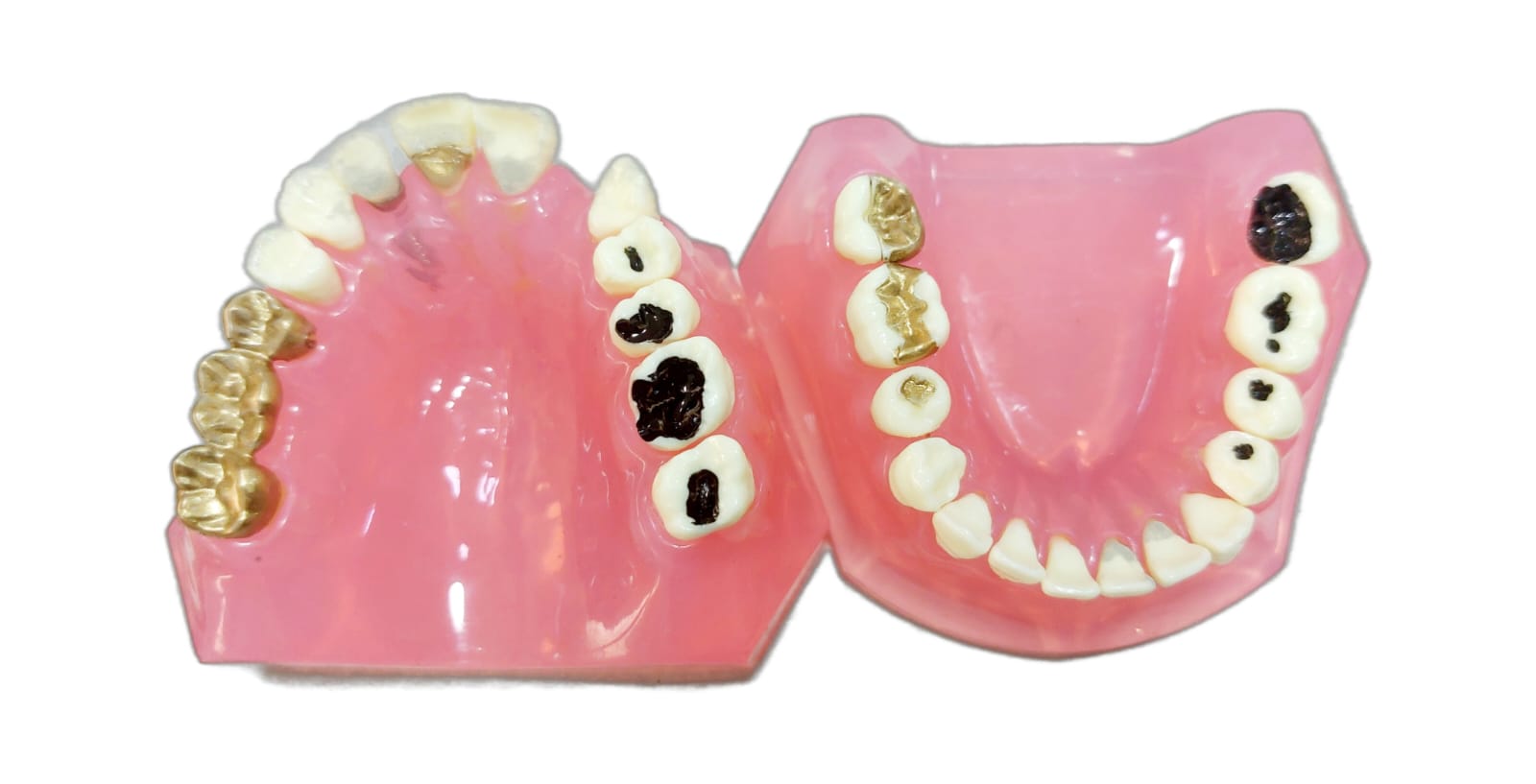 Caries Treatment Model Before & After