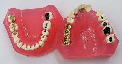 Caries Treatment Model Before & After