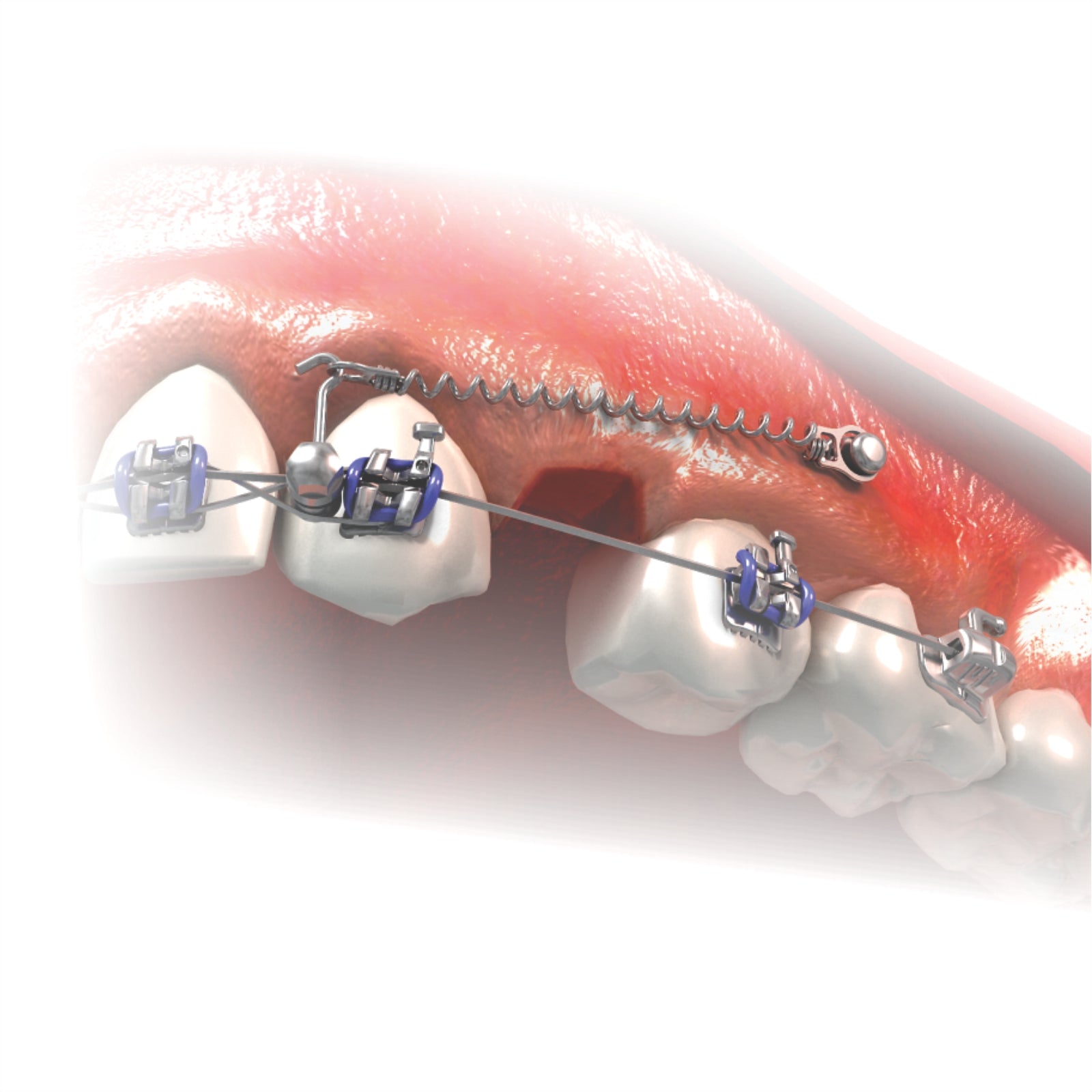 Titanium Orthodontic Miniscrew with Button Head