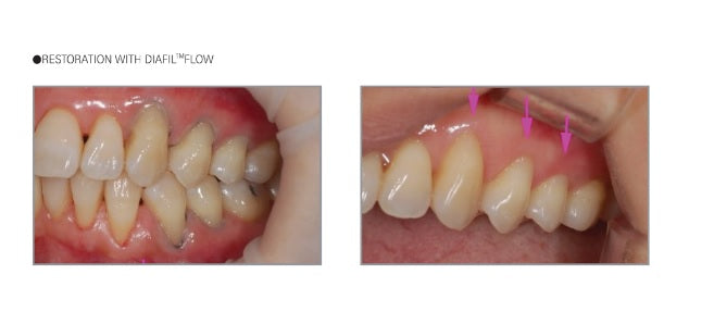 DIAFIL FLOW - Light Cured Flowable Restorative Composite Resin