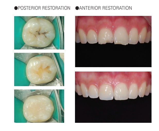 DIAFIL - Light Cure Esthetic Restorative Nano Hybrid Composite Resin