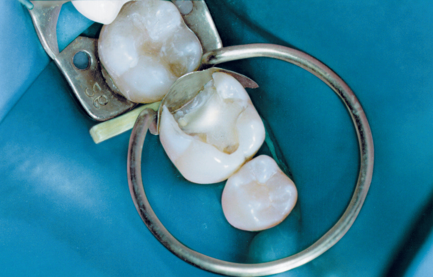 Unimatrix Rings - Preformed sectional matrix system for class II restorations