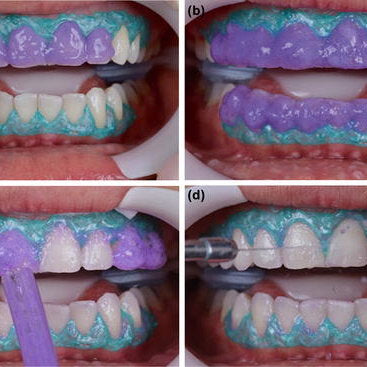 Whiteness Hp Blue - Hydrogen peroxide at 35%