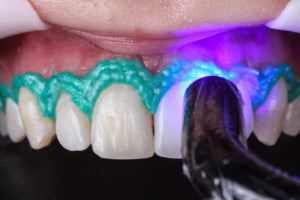 Top dam blue - Light curing gingival barrier.